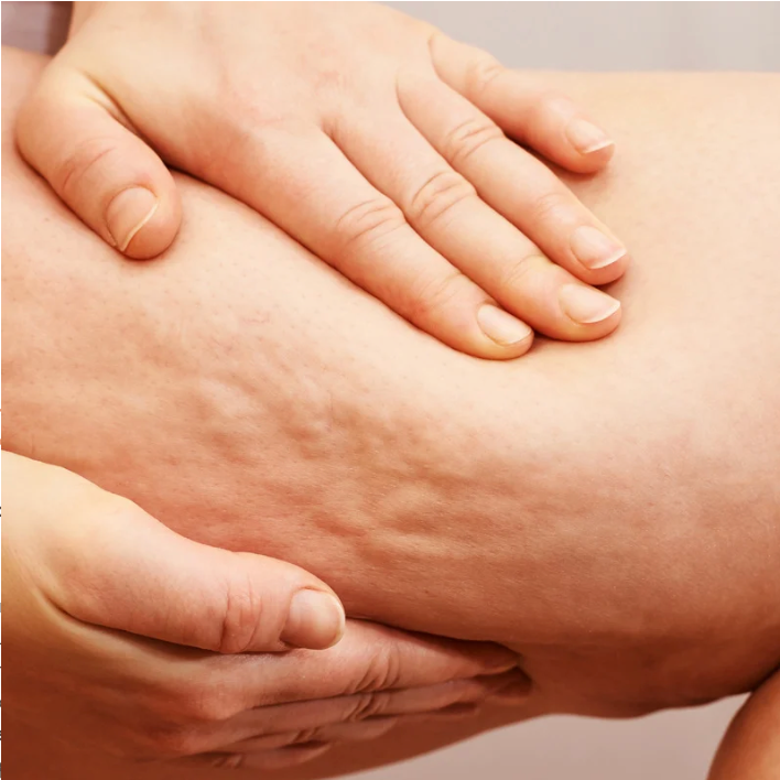 Pack cellulite modérée (cellulite adipeuse liée au stockage des graisses) 8 semaines